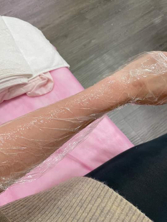 【雷射除毛】第二次除手毛，醫生說我的手毛已經變細少了，希望在夏天前除完！！！-咪塔 Mita