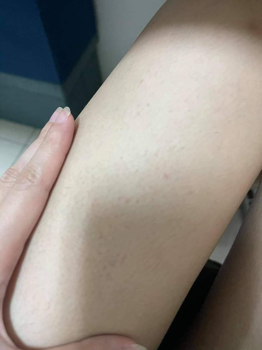 【雷射除毛】準備迎接夏天到來，辣妹走起～！！！-Ada 張佳佳