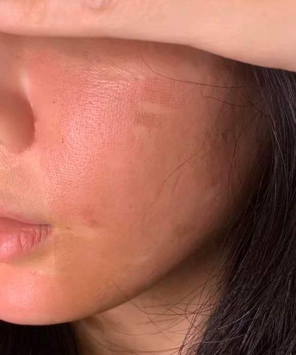 【雷射除毛】 治療毛孔、凹洞與阻止皮膚老化方面有改善效果外，更提供最少副作用與最短恢復期！！！~-Misa小羽