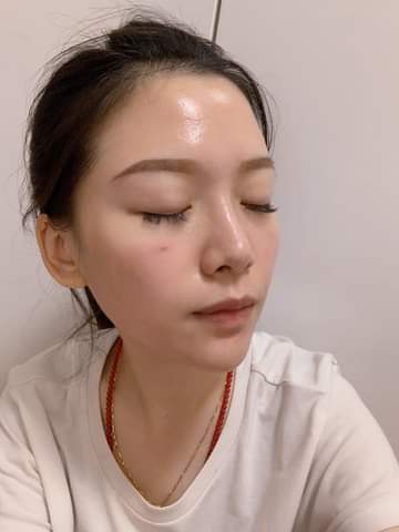 【杏仁酸煥膚】疫情期間戴口罩的日子導致皮膚狀況糟透了～ 來星和處理惱人的口罩痘 ~-曾琬婷