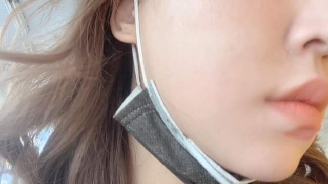 【飛梭雷射 】本來的凹疤跟脫皮，還有不吃妝，ㄧ個禮拜後妝效大家都驚艷無比，每次打完真的都讓我太開心！！！！～-Misa小羽
