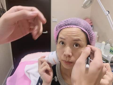 【肉毒桿菌】 打完回到家其實完全無感呀，隔天也能正常上妝工作，大家根本不知道我偷偷動了手腳！！！～-Cinya的私房烘焙課