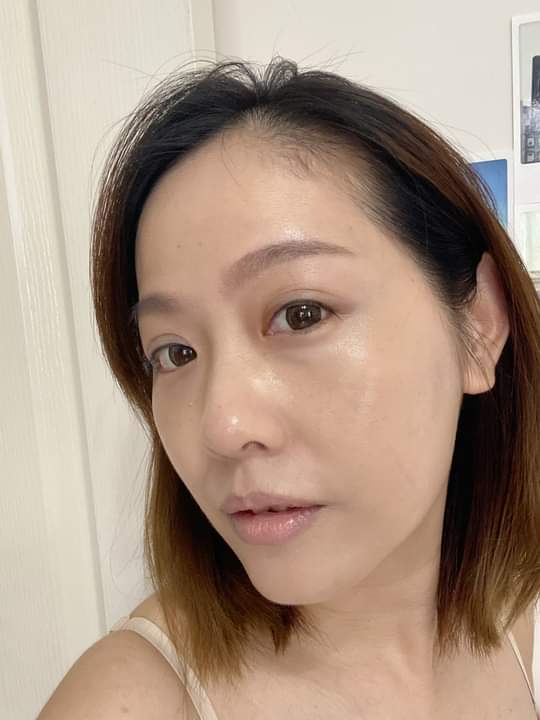 【杏仁酸煥膚】週年慶忙到皮膚狀況超差,結束後立馬衝去星和做杏仁酸擠粉刺,又回到平滑光澤肌ㄌ！～！！！ ~-Vivi Wu
