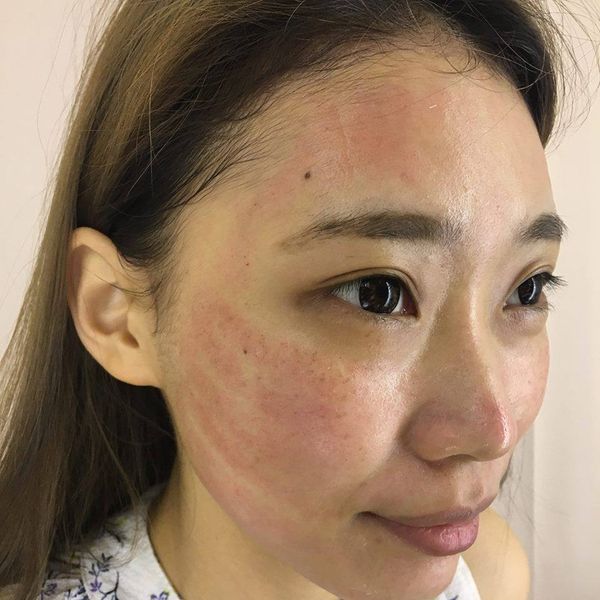 【皮秒雷射】就這樣我的第一次獻給了皮秒