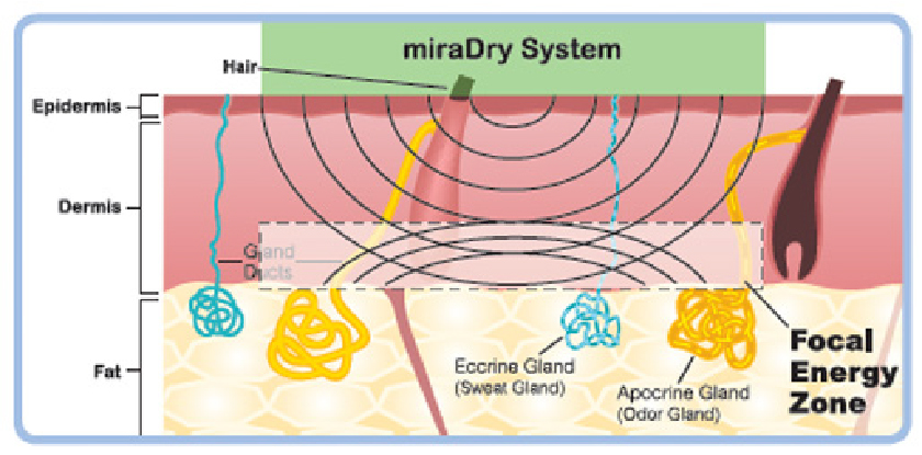 星采古亭_Miradry腋淨爽_葉姿辰醫師04