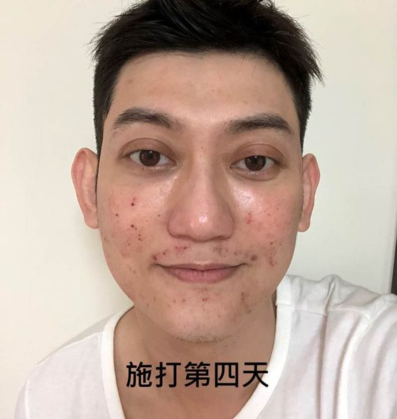 【皮秒雷射】快來試試「皮秒雷射」掃除臉部黑色素，術後的肌膚真的改善