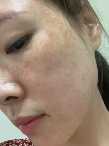 【皮秒雷射】星和診所/台中醫美-吳詩韻醫師- 素顏的皮膚也可以很好-Disni's Wonderland