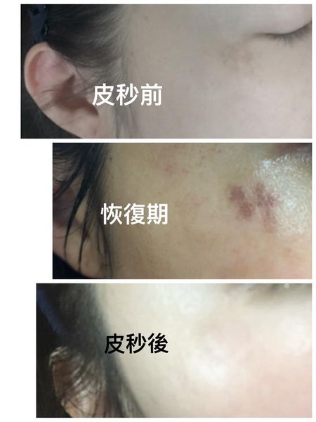 【皮秒雷射】▎皮秒雷射 X 孕媽咪的除斑人生  ▎