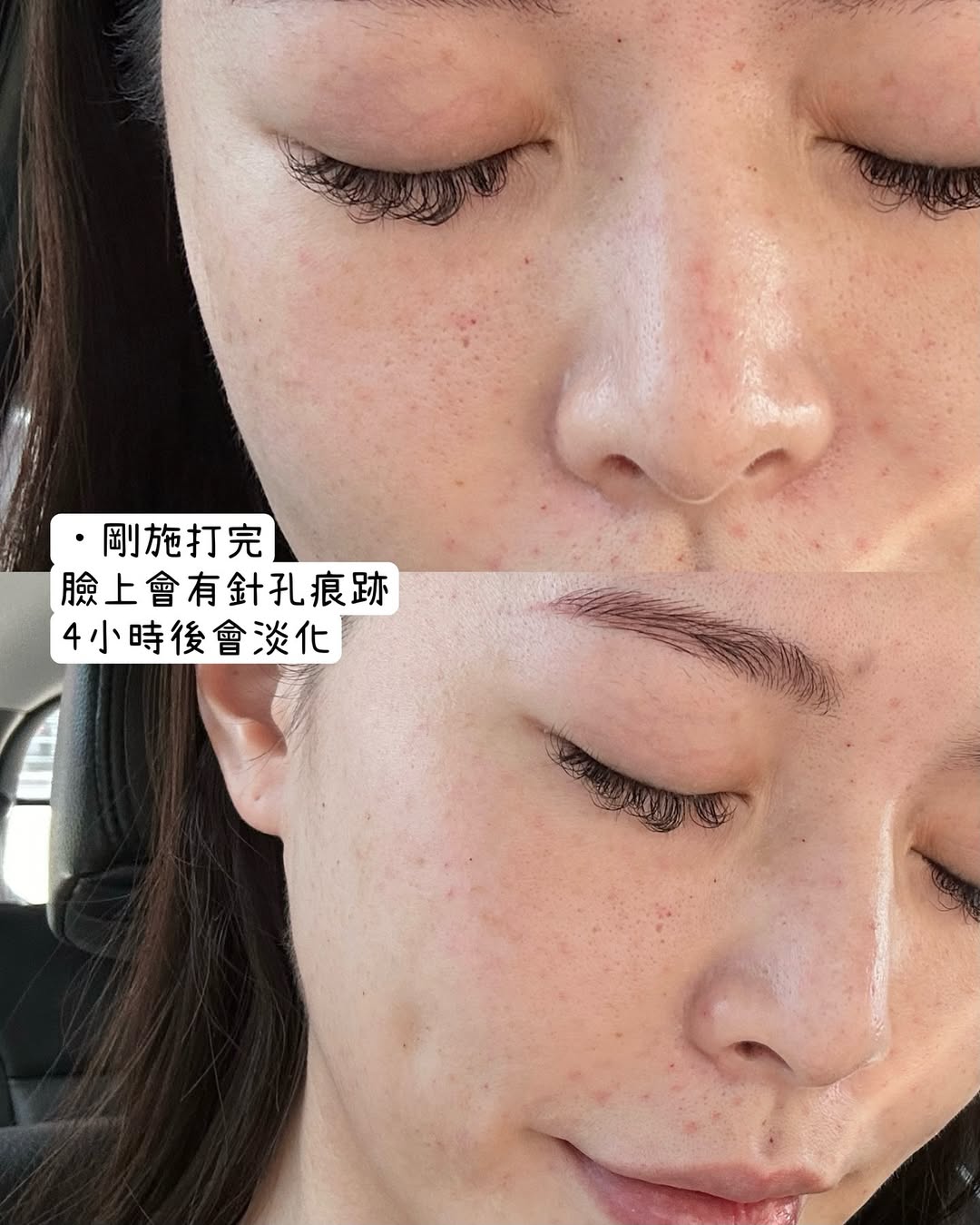 星和診所（新竹市）-水光注射(俗稱水光針)