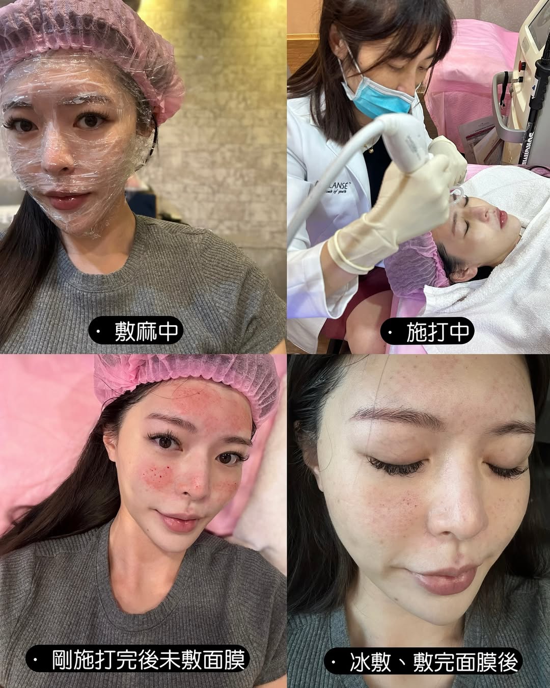 星和診所（新竹市）-水光注射(俗稱水光針)