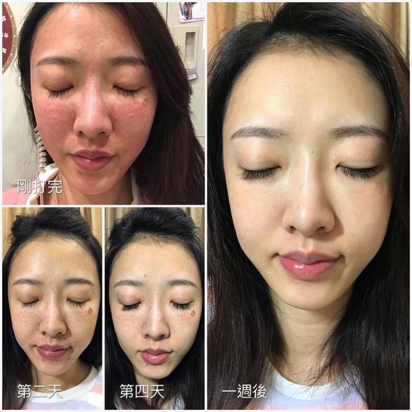 【皮秒雷射】雷射界的超跑