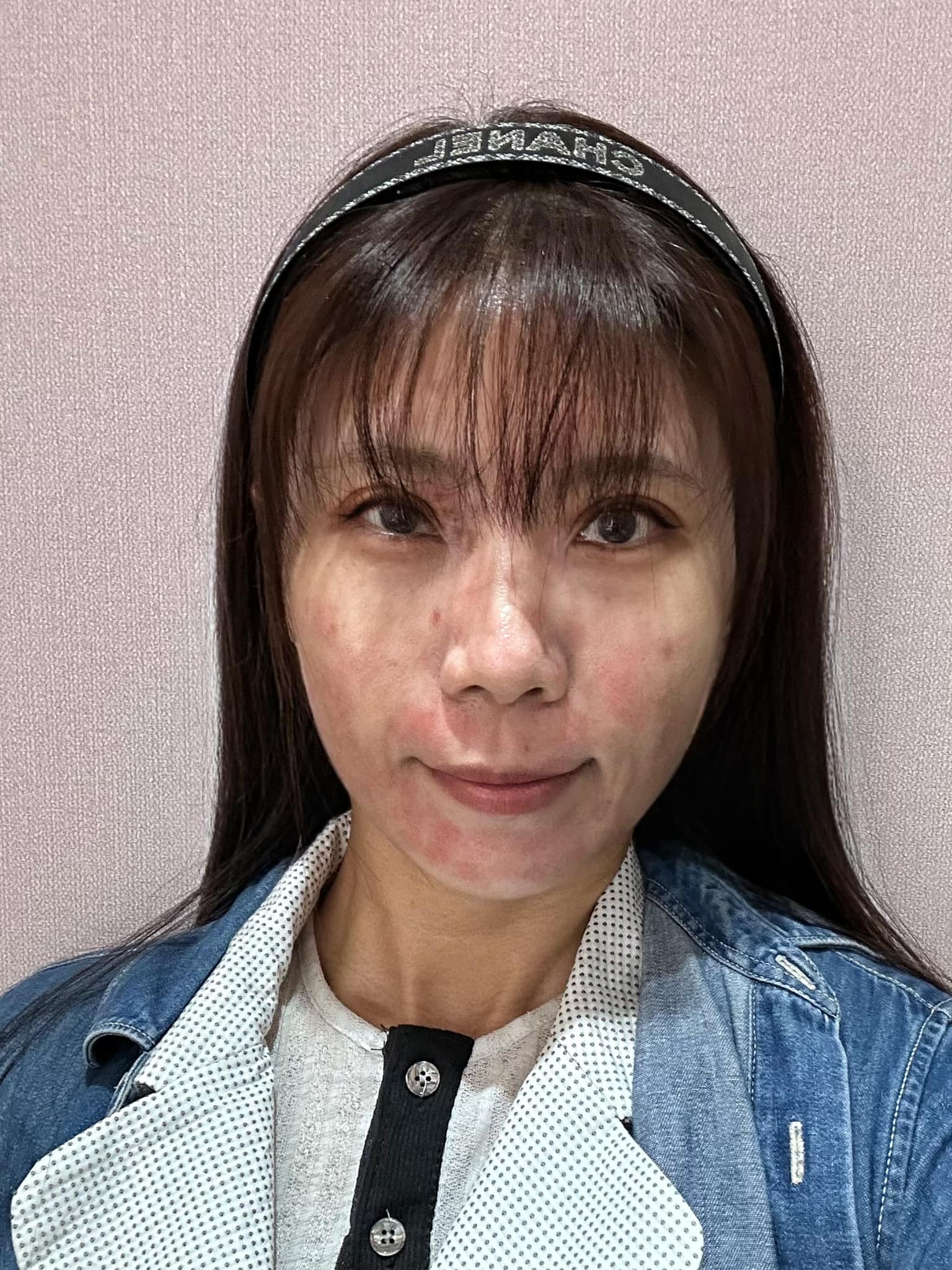 仁愛星和診所-皮秒雷射