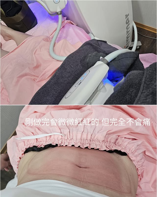 完全不會痛