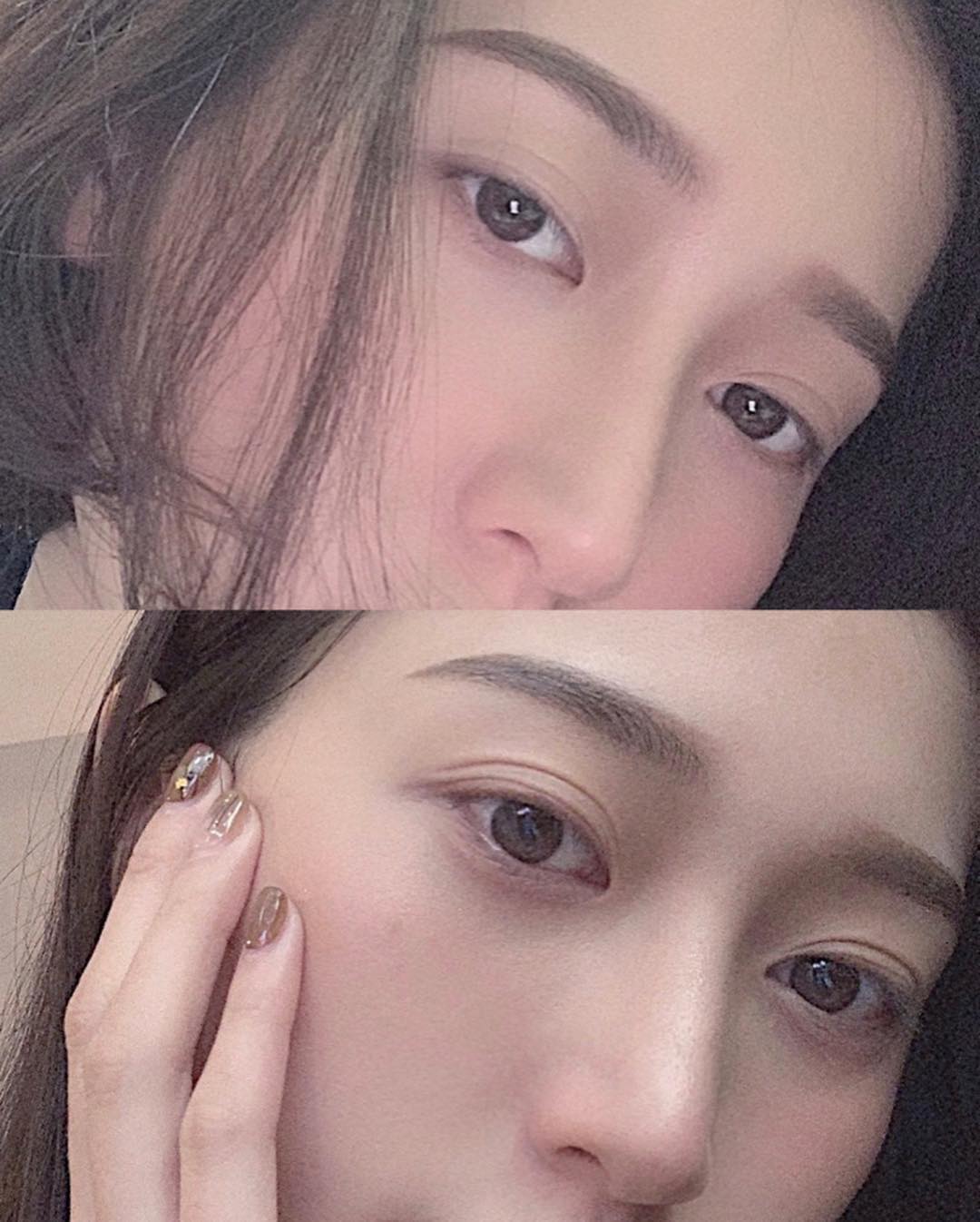 【彩衝光】星和診所（新竹市）林明潔醫師-淺層痘疤都變得比以前淡了😳_蘇雨