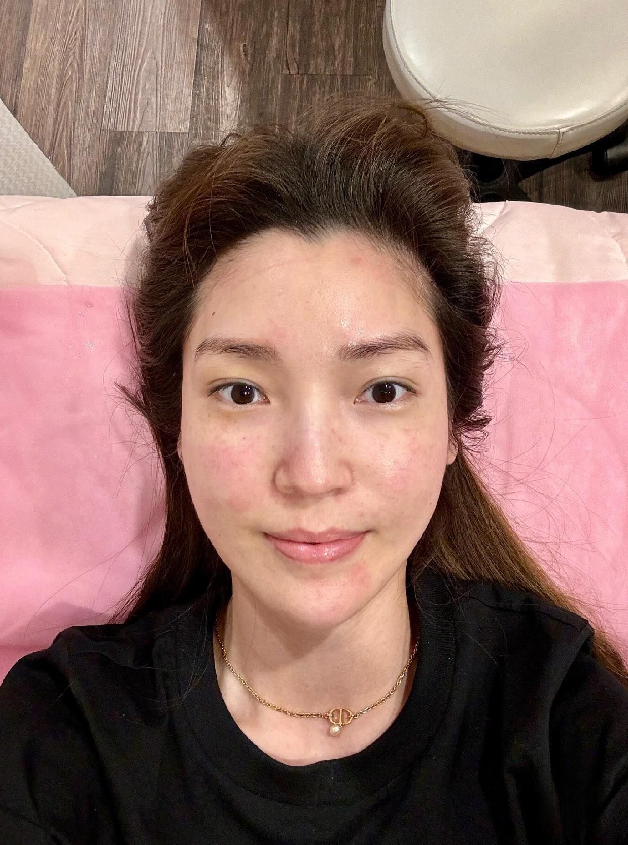 水光玻尿酸可達到皮膚透亮有光澤