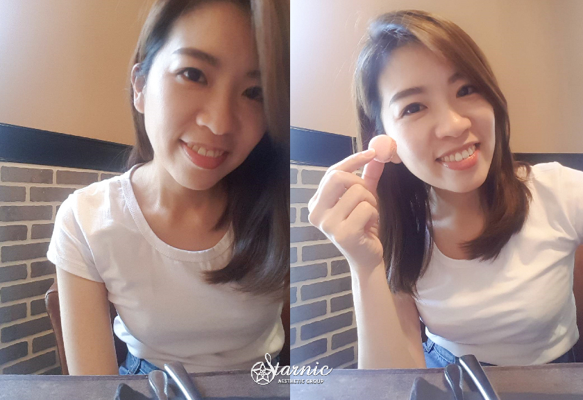 星和診所_Ulthera優珊納極線音波_張寒貞