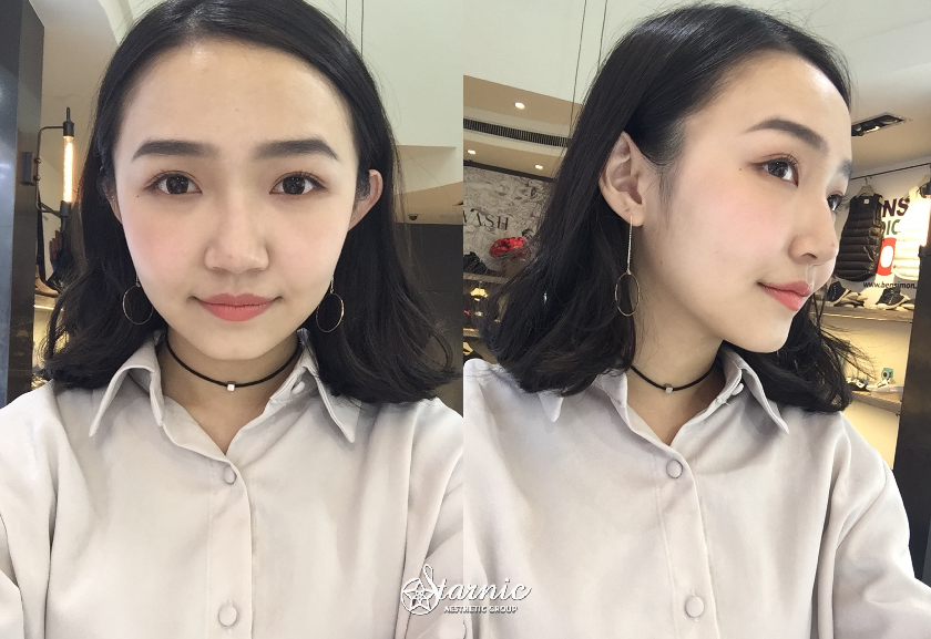 星和_Ulthera優珊納極線音波_蔡明薰07
