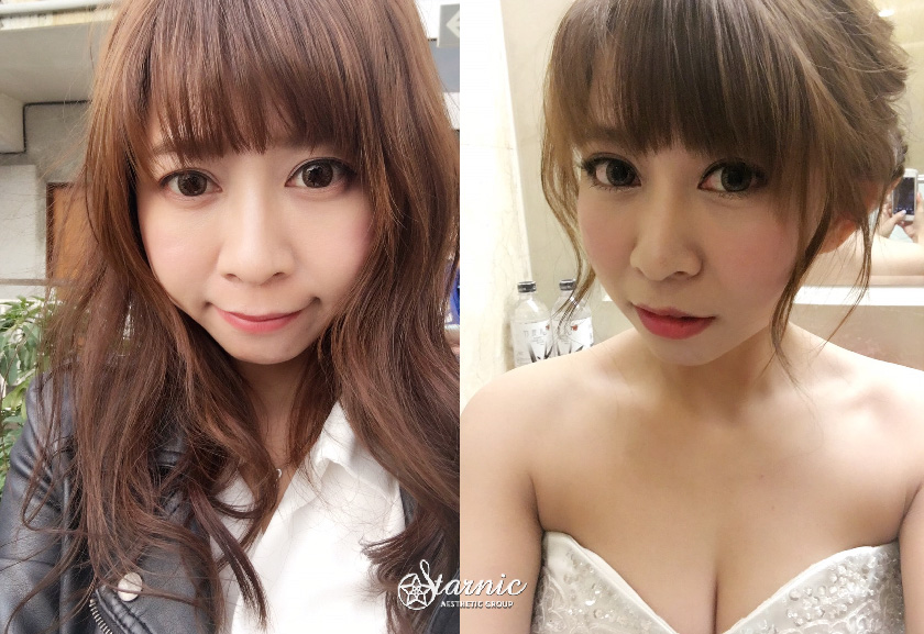 星和診所_玻尿酸填補淚溝、蘋果肌_金紫燕