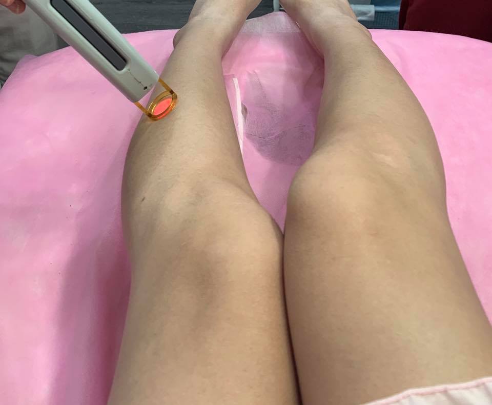 【雷射除毛】星和診所-館前路(台北) 葉姿辰醫師-敷完舒緩膏就可以繼續去逛街囉🤣_yj蘇郁喬(feelbe)