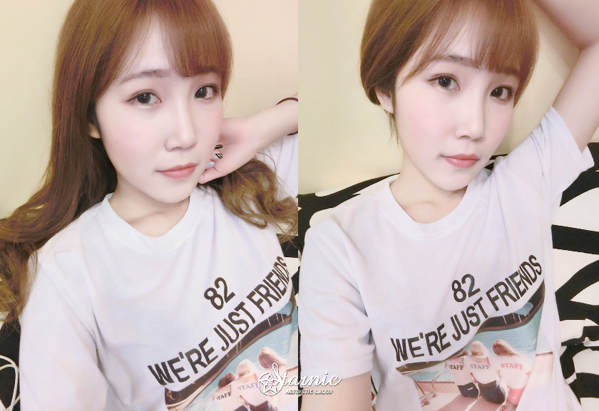 星和診所_肉毒瘦小臉_曾鈺婷