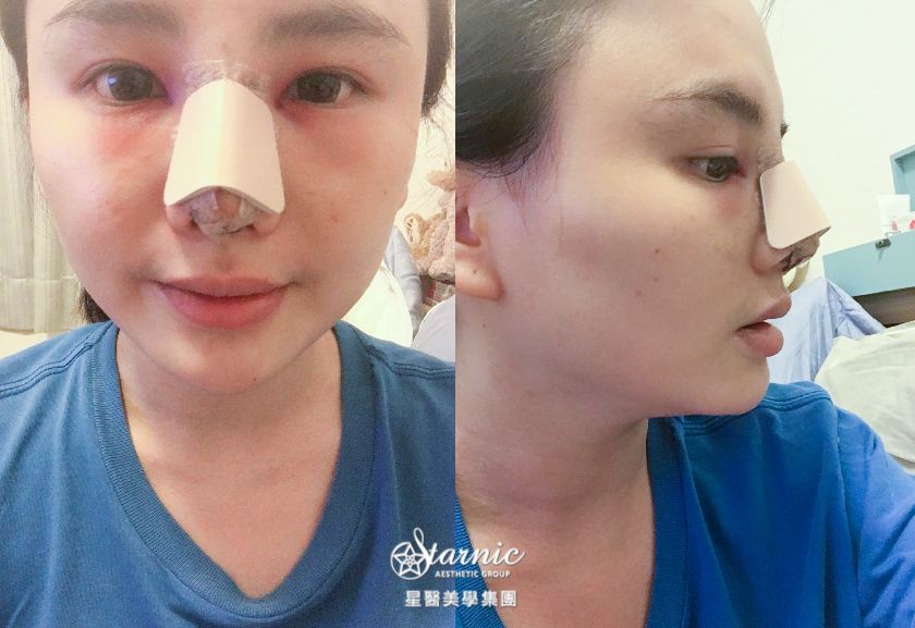星采大安_自體肋軟骨隆鼻_邱大睿醫師08