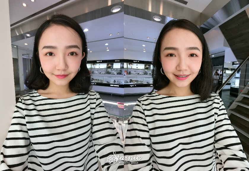 星和_Ulthera優珊納極線音波_蔡明薰08