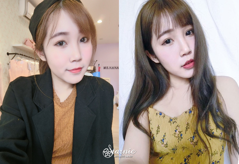 星和診所_肉毒瘦小臉_曾鈺婷