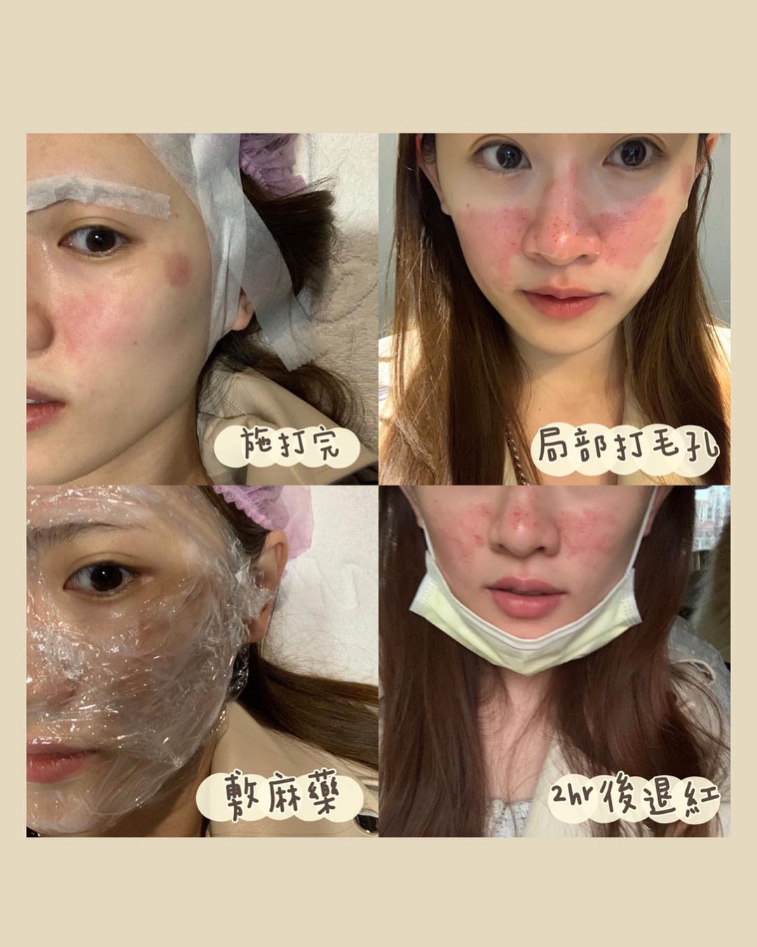 【皮秒雷射】自強星和診所（竹北） 張惟皓醫師-每天帶口罩真的很適合打雷射_庭柔