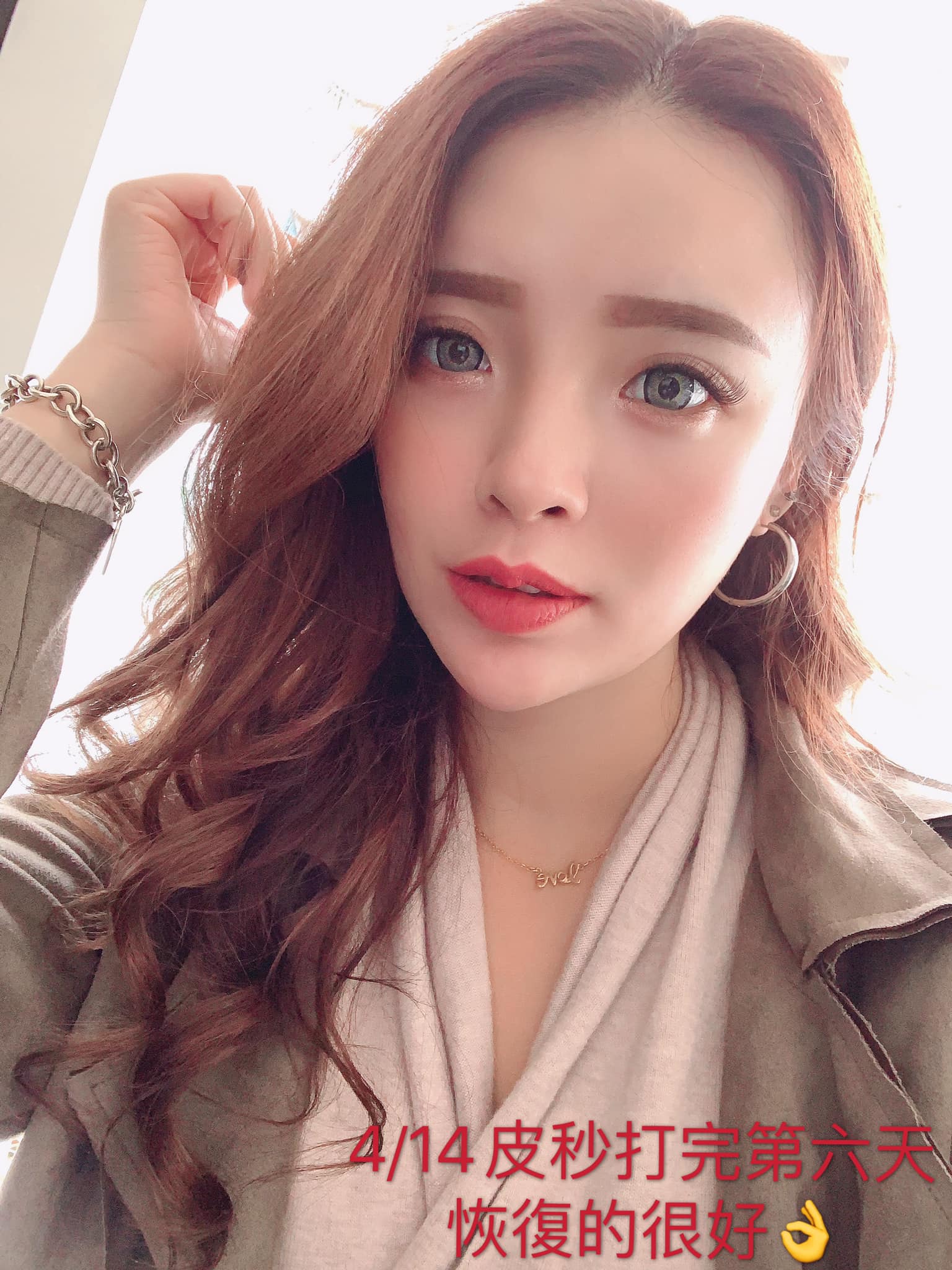 【皮秒雷射】星和診所-高雄市 劉勇甄醫師-雙機模式皮秒可以一次解決所有的綜合問題,打完比起其他的雷射修復期更短-Chi Chi棋棋