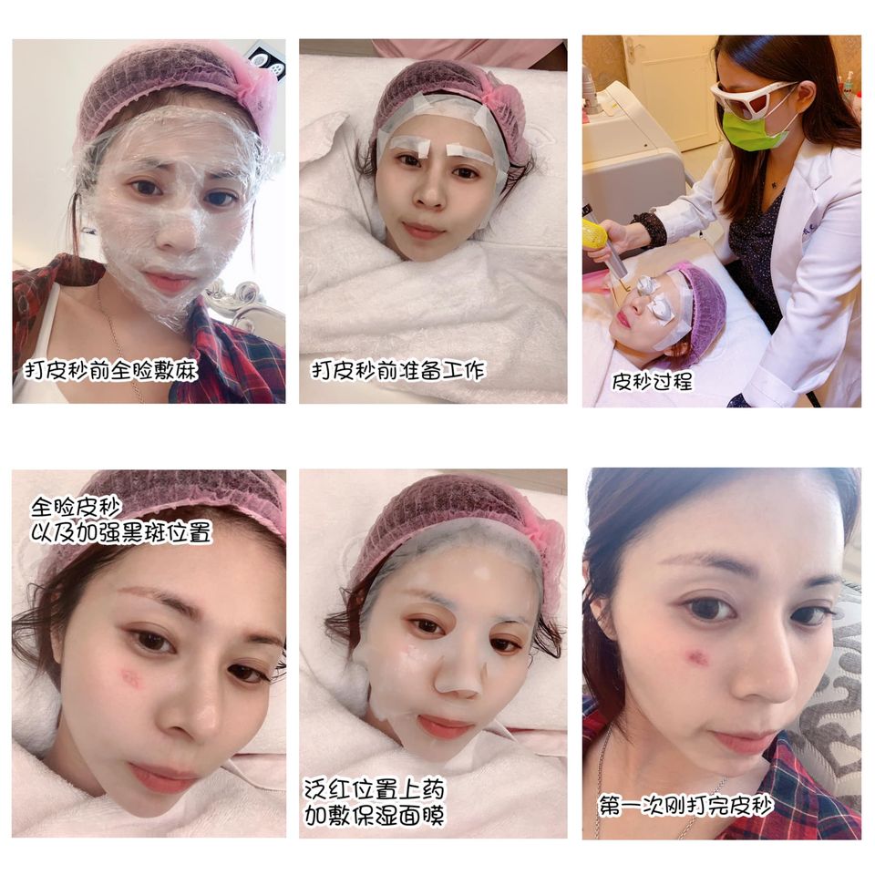 【皮秒雷射】星和診所-桃園市 葉姿辰醫師-下定決心去把左臉眼下的黑斑除掉_顏蟲蟲