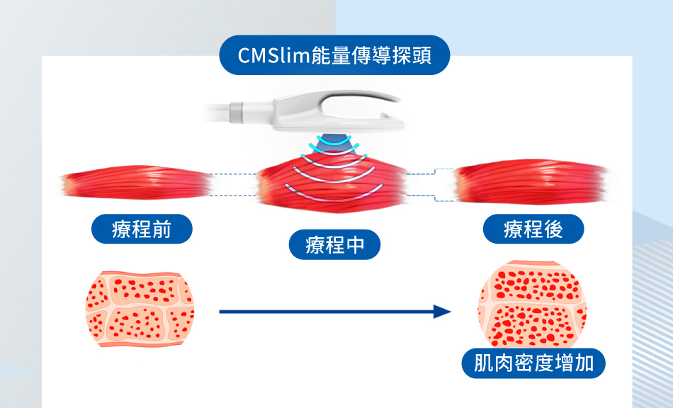 CMSlim的探頭怎麼刺激肌肉