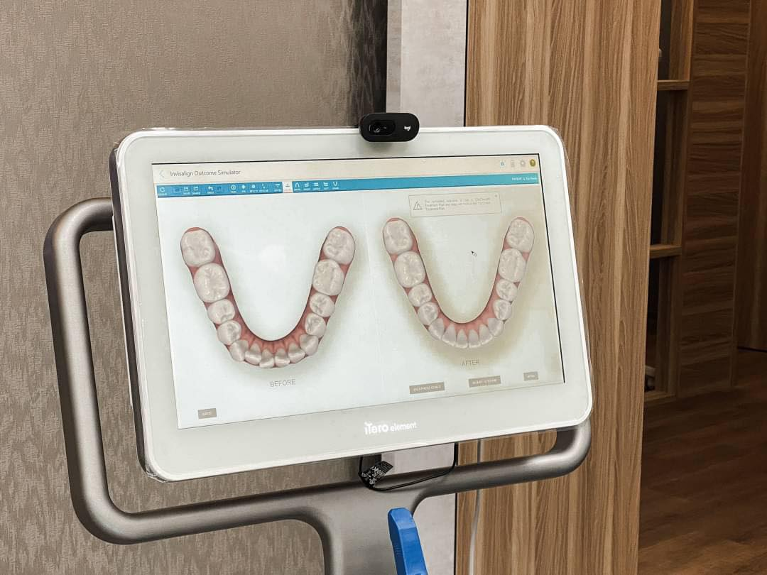 以數位3D模型模擬YA!Smile二代隱形矯正後的效果