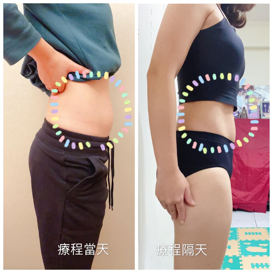 增肌減脂醫美推薦：「星采星和診所」Emsculpt 肌動減脂效果對比圖