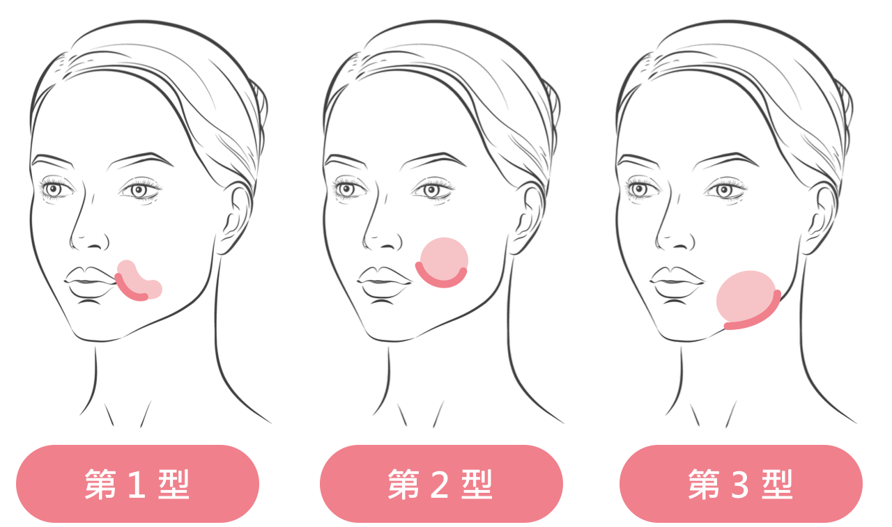 嘴邊肉下垂類型