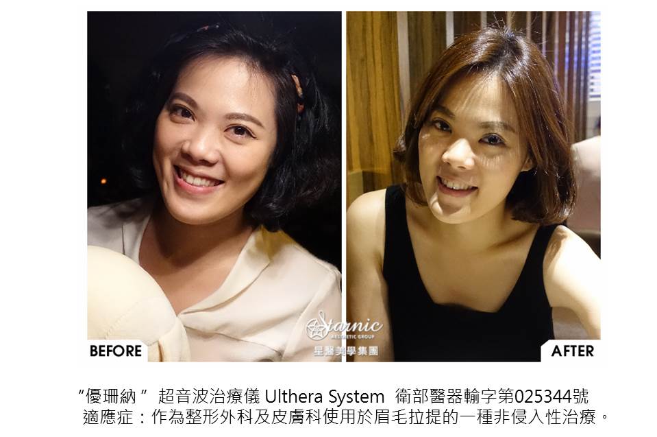 星和台南_Ulthera極線音波拉提_院長鄭玉貞醫師13