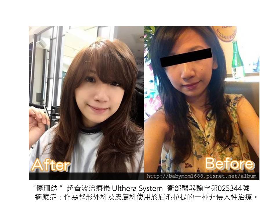 【極線音波拉提】星采皮膚專科診所(古亭)-30拉警報之~傳說中的Ultherapy極線音波拉提_貝貝媽