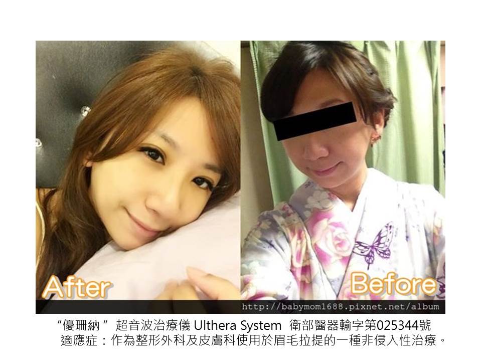 【極線音波拉提】星采皮膚專科診所(古亭)-30拉警報之~傳說中的Ultherapy極線音波拉提_貝貝媽