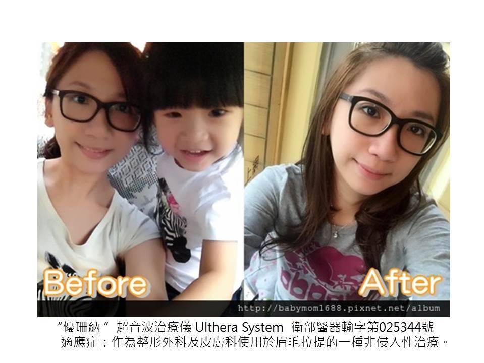 【極線音波拉提】星采皮膚專科診所(古亭)-30拉警報之~傳說中的Ultherapy極線音波拉提_貝貝媽