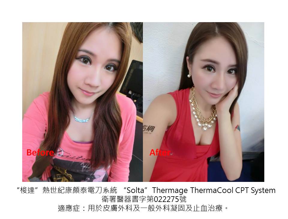 星和_電波拉皮＋晶亮瓷填補下巴_貴婦02