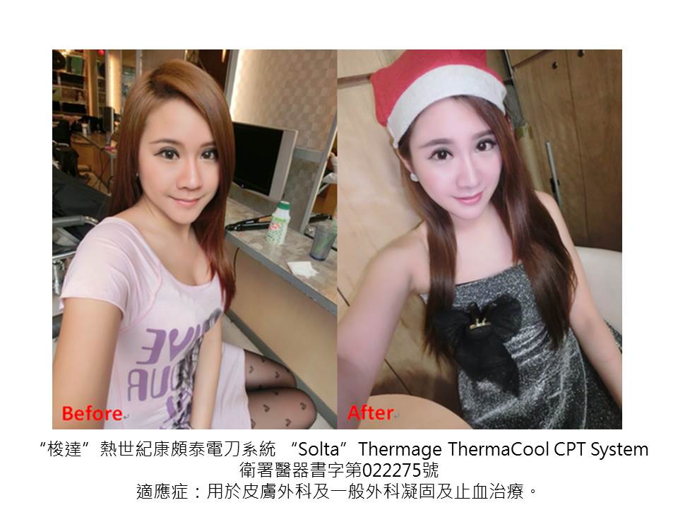 星和_電波拉皮＋晶亮瓷填補下巴_貴婦08
