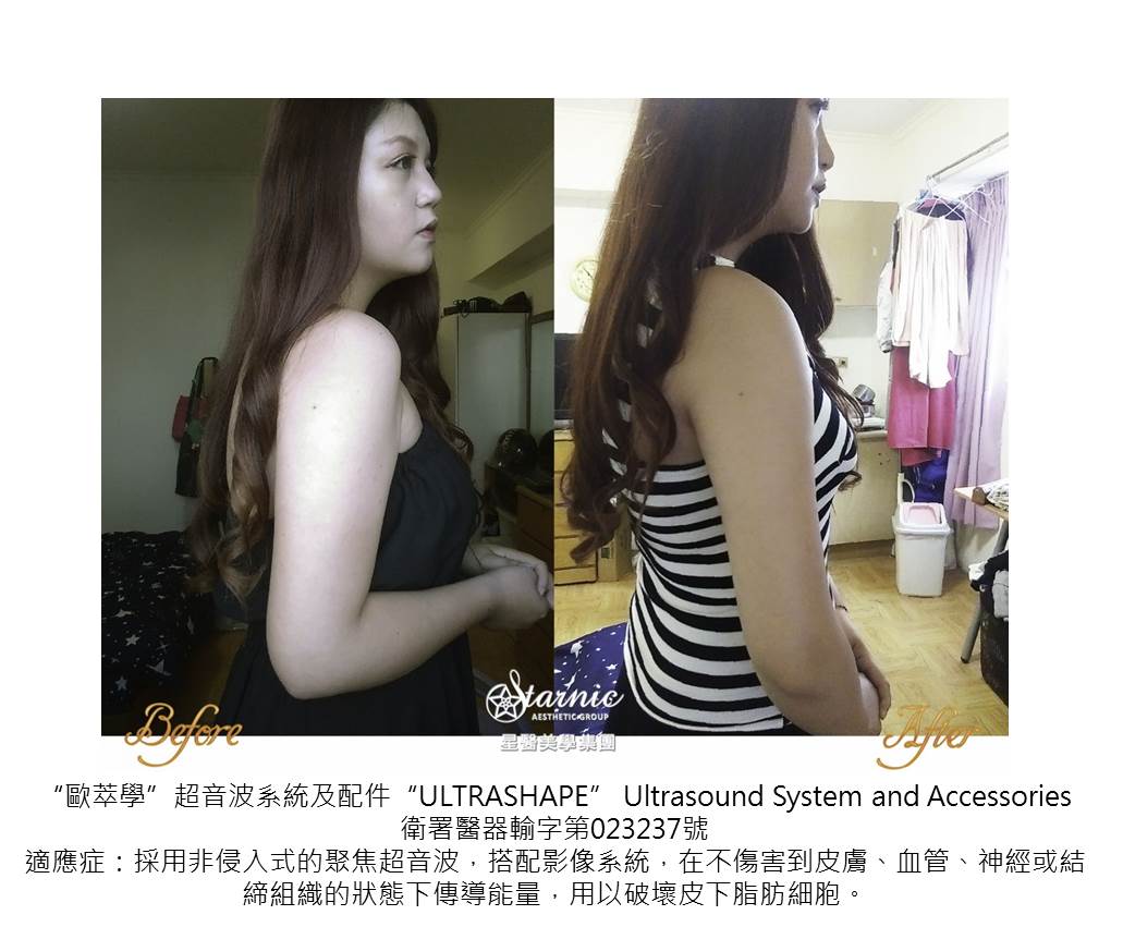 星和高雄_歐萃學超音波系統(標靶震波)_賴衍翰醫師01