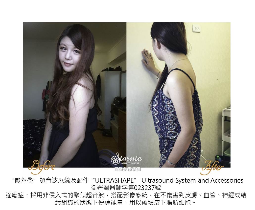 星和高雄_歐萃學超音波系統(標靶震波)_賴衍翰醫師17