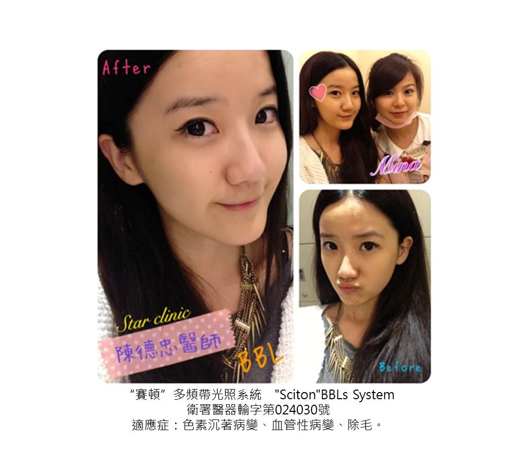 高雄醫美星和診所_脈衝光_陳青青、Cherry Wang、Cat Ling 