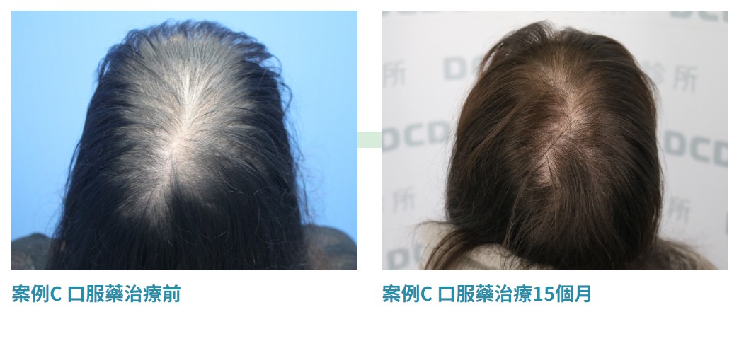 DCDC植髮診所口服藥治療案例C