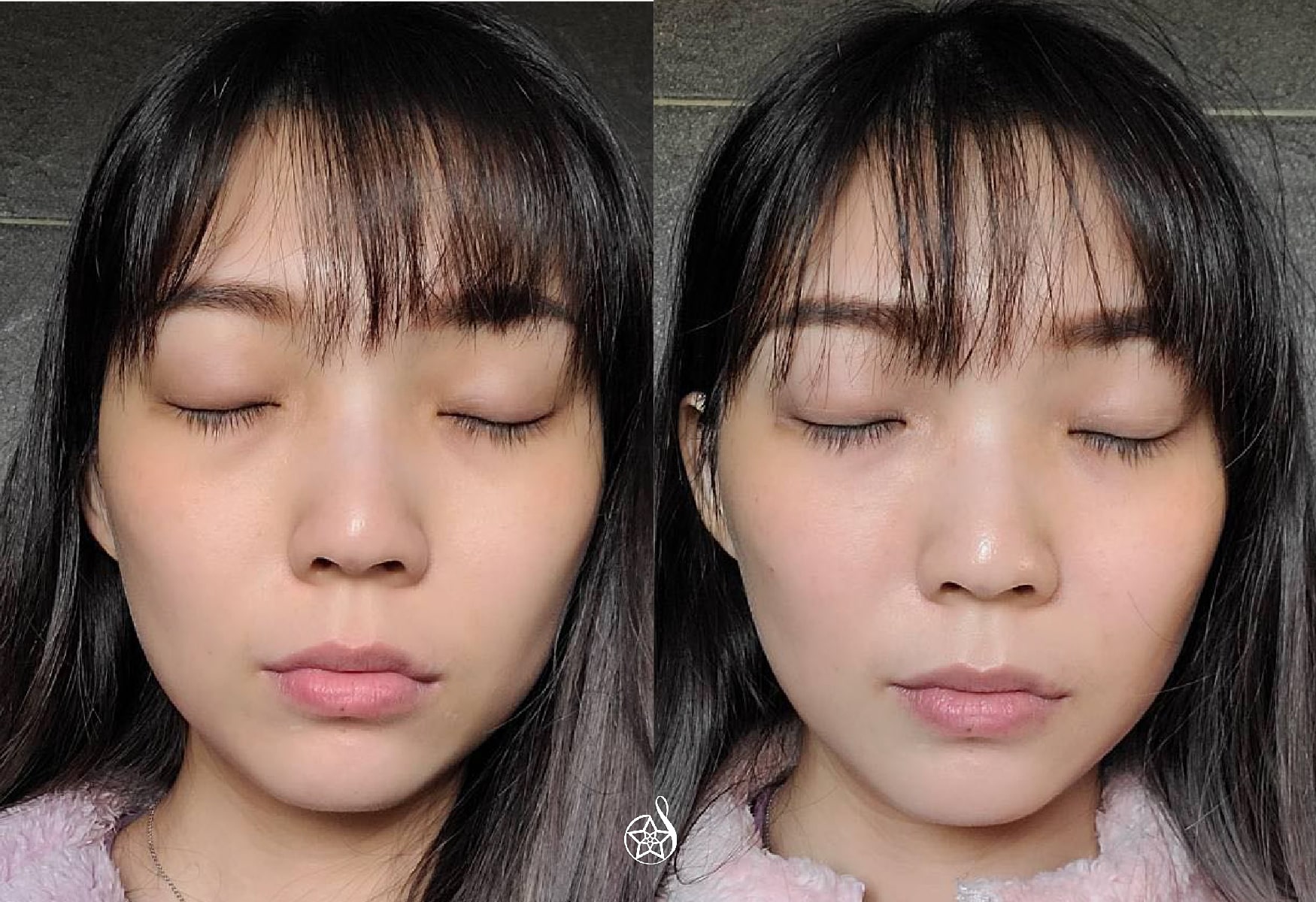 玻尿酸填充是幫助填補眼下凹陷處，處裡眼下細紋的醫美方法