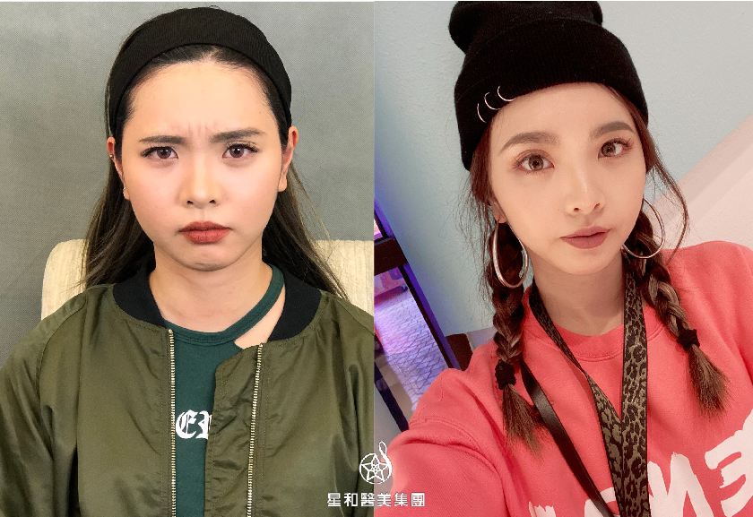 【肉毒瘦小臉+除皺】星和診所/台南醫美-改善大小臉！愛美就追求不需要隱瞞-雙胞胎媽咪阿普