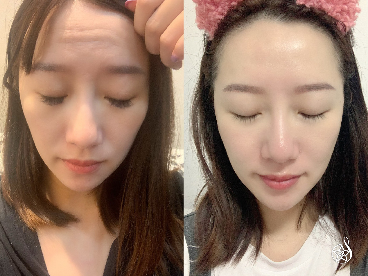 【微整除皺】星和診所/台南醫美-阻止動態紋變靜態紋！讓眉頭不再深鎖的終極救援-小芬
