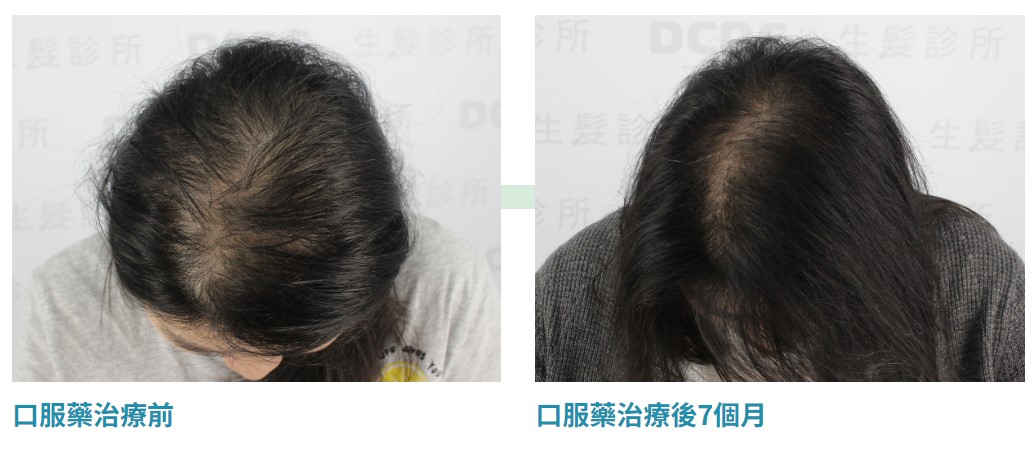 女性雄性禿植髮手術與SMP治療