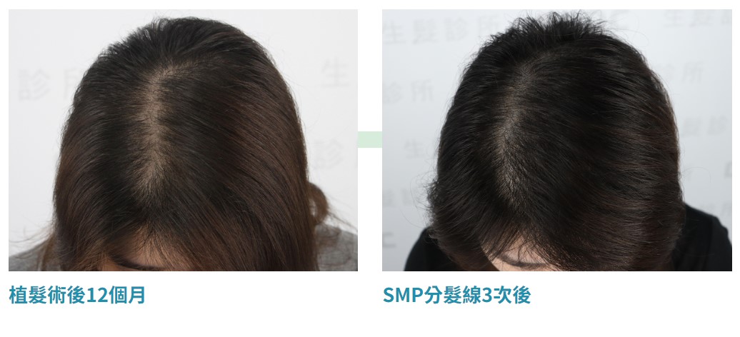女性雄性禿植髮手術與SMP治療效果