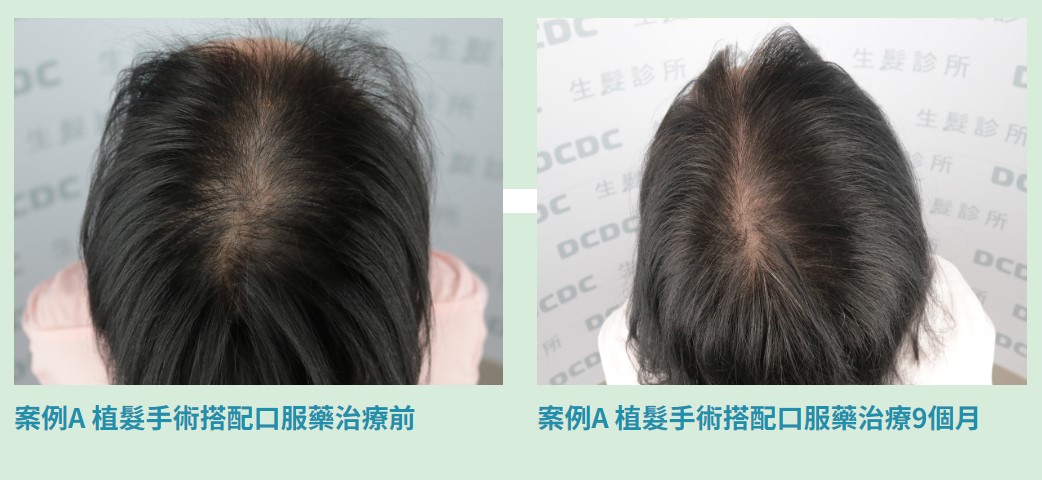 植髮手術搭配口服藥治療過程